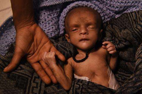 Lille baby underernæret holder mor i hånden. Cox's Bazar, Bangladesh. 